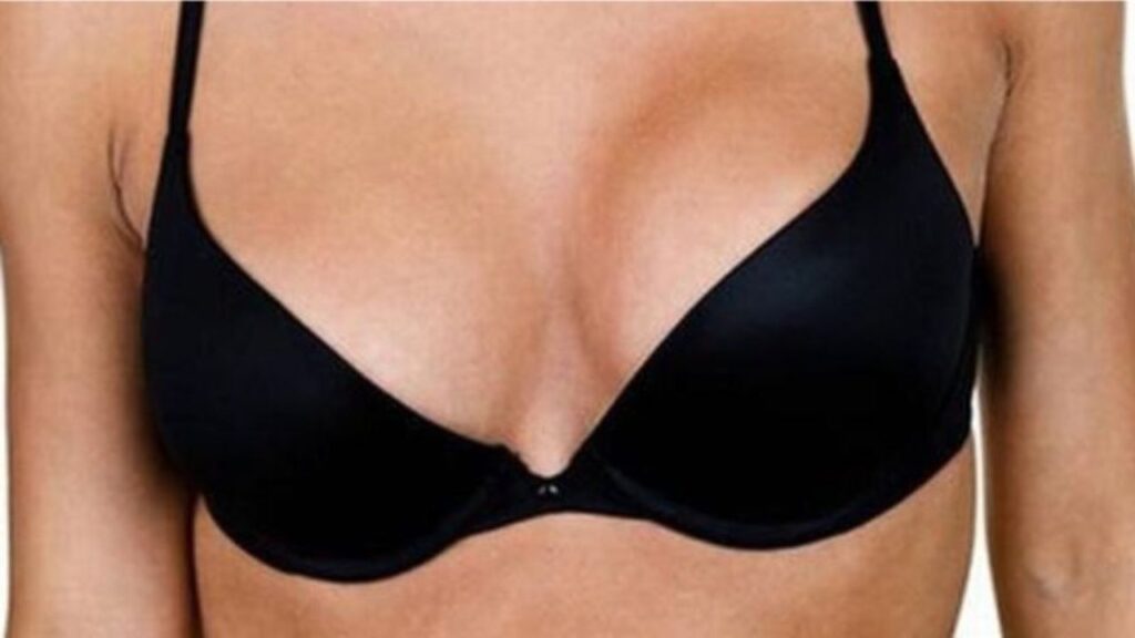 Nâng ngực bị lệch túi có sửa được không? Phác đồ sửa ngực hỏng 2026