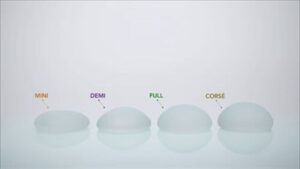 Tư vấn size túi ngực cho người thấp bé (dưới 1m50): 200cc hay 250cc là tỷ lệ vàng