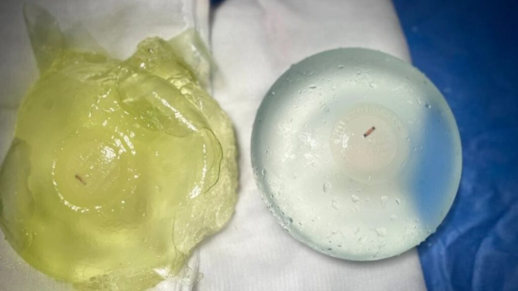 Nâng ngực có bị bao xơ không?Nguyên nhân, dấu hiệu nhận biết sớm và cách xử lý triệt để