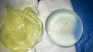 Nâng ngực có bị bao xơ không?Nguyên nhân, dấu hiệu nhận biết sớm và cách xử lý triệt để