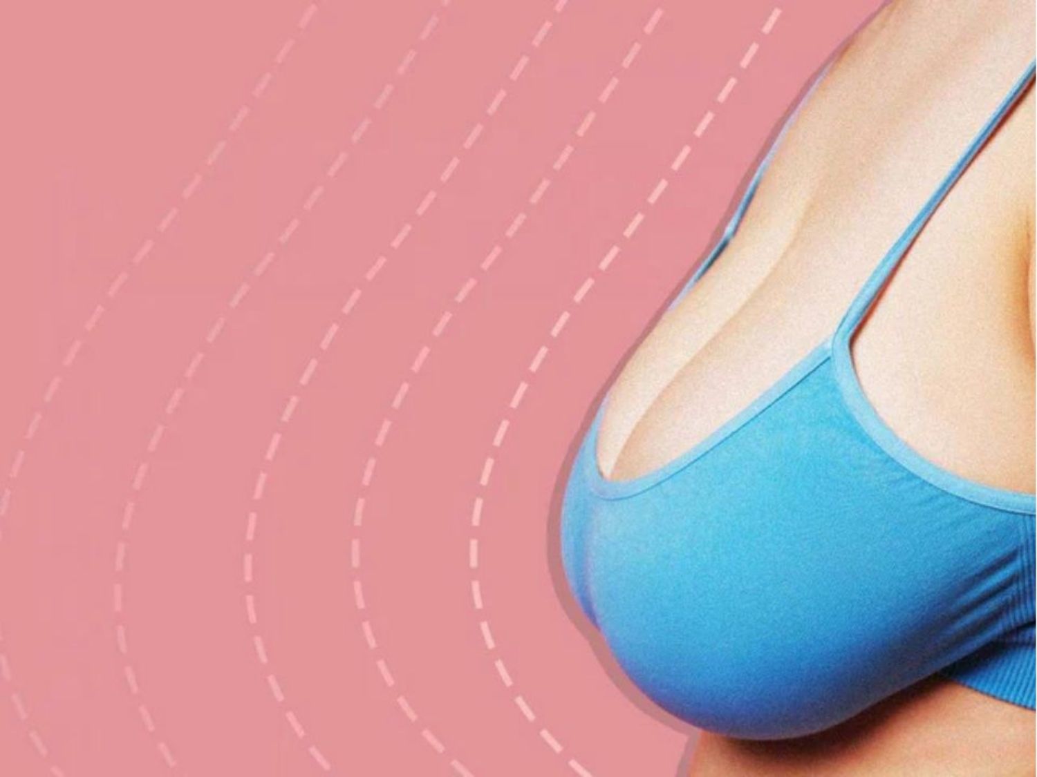 mô tả tình trạng sa trễ ngực, bầu ngực tụt xuống thấp, vị trí núm vú thấp