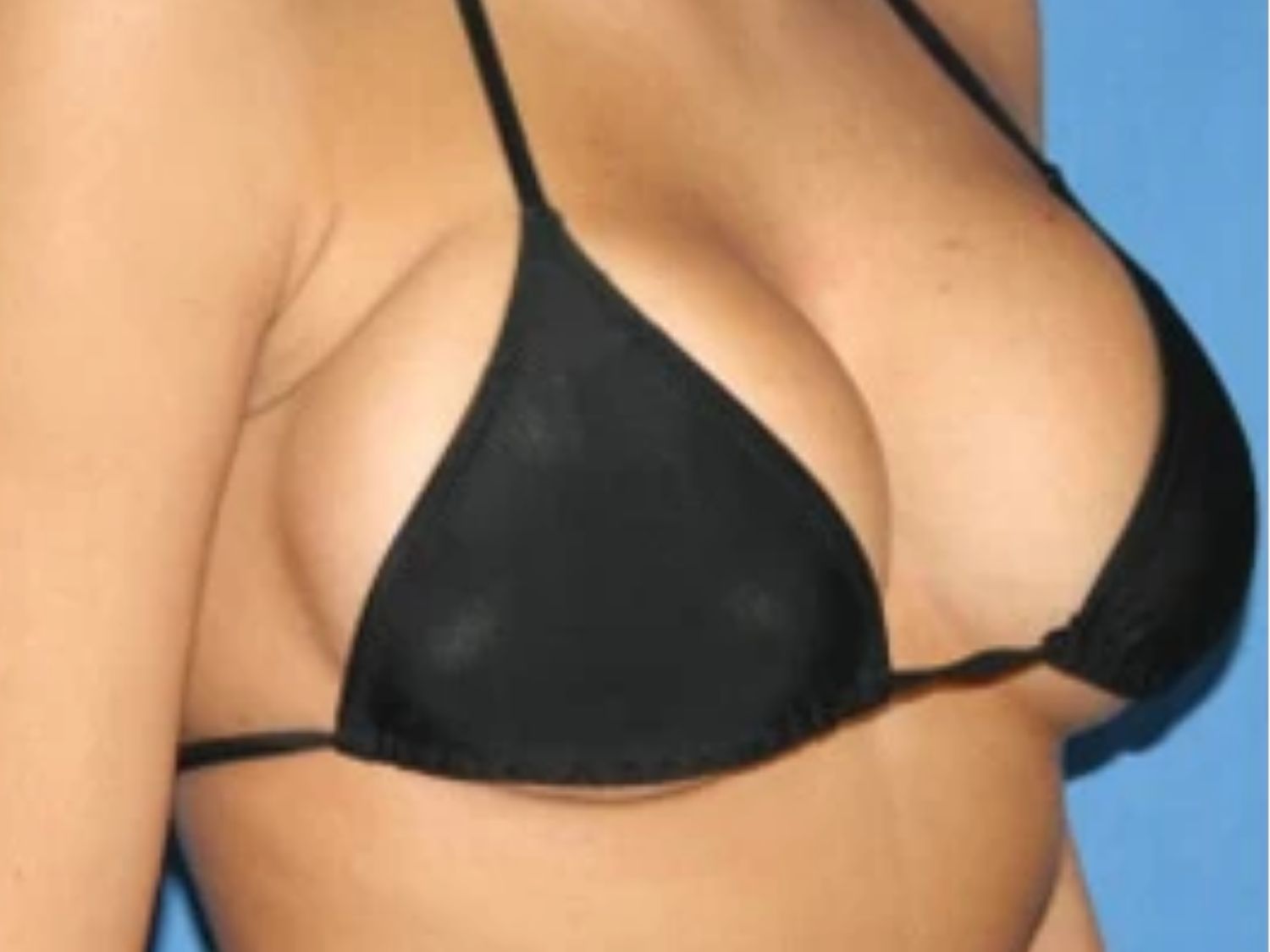 ngực giả do đặt size túi quá to so với vóc dáng