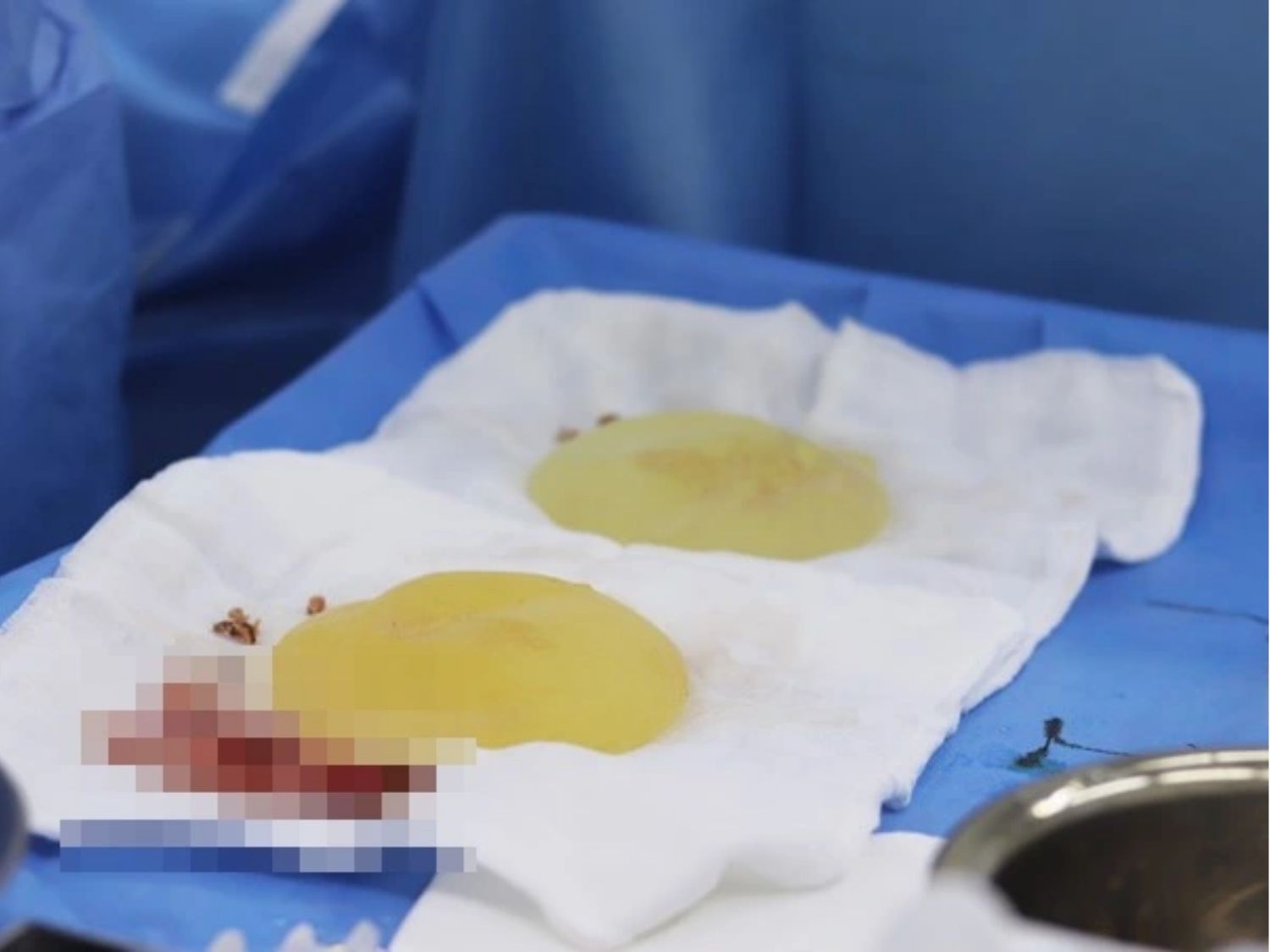 đây là tình trạng bao xơ sau nâng ngực, túi ngực cần tháo bỏ khi bị bao xơ