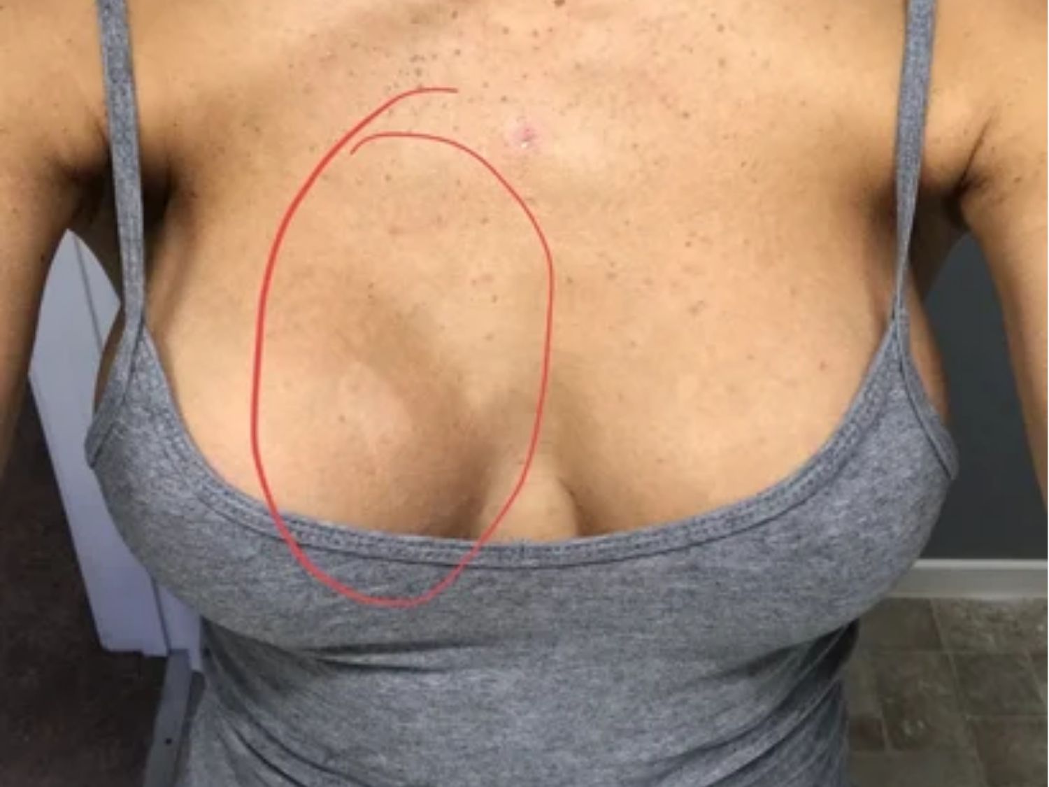 Lộ túi sau nâng ngực, các cạnh hoặc bề mặt của túi độn hiện rõ lên dưới da