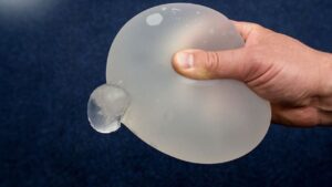 Nâng ngực có bị vỡ túi không? Sự thật về tuổi thọ túi độn và 3 dấu hiệu vỡ im lặng