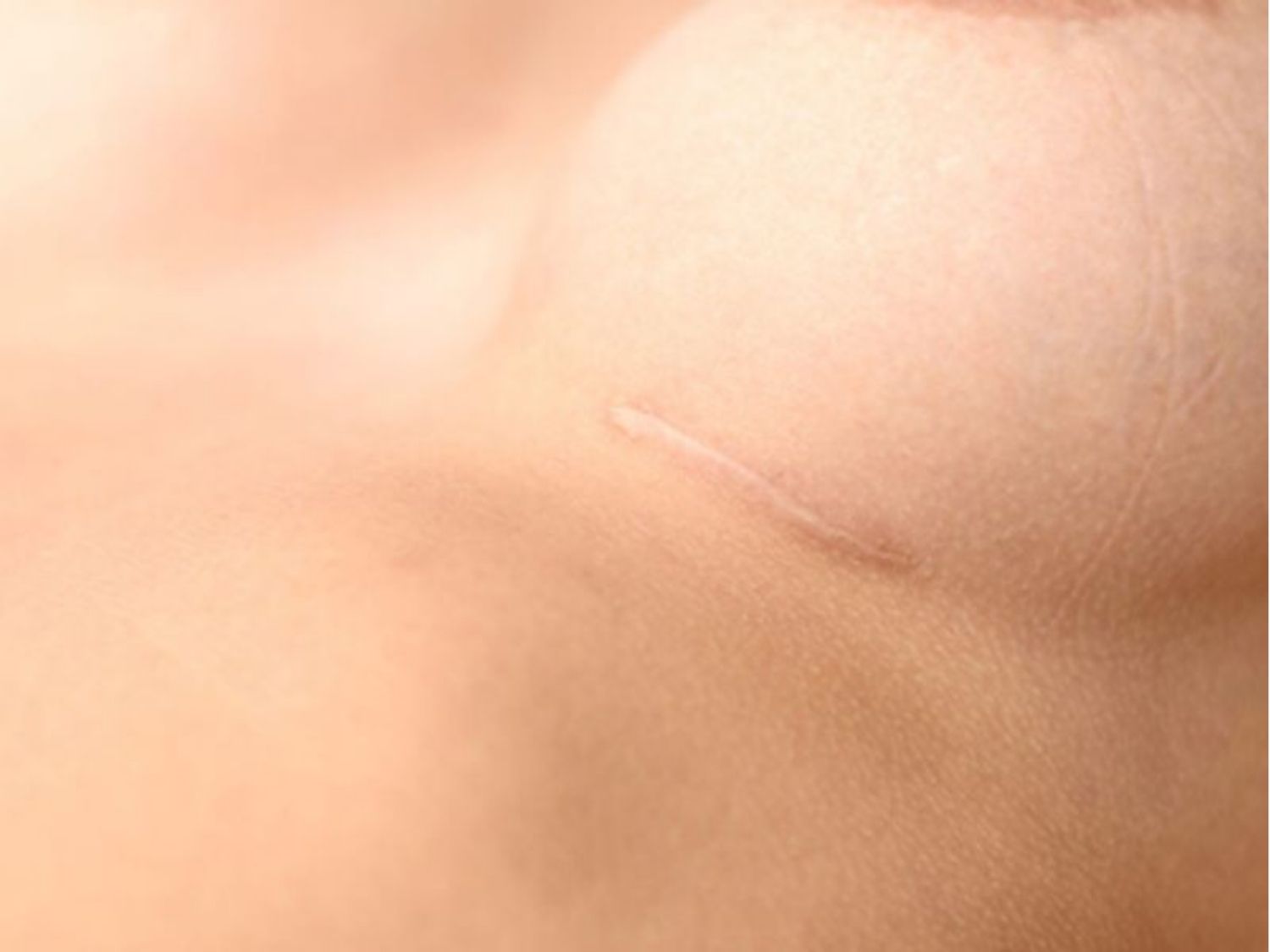 đường mổ ở chân ngực giấu sẹo tốt nhất vì nằm ở nếp lằn dưới vú, vị trí không lộ ra và ít bị lộ