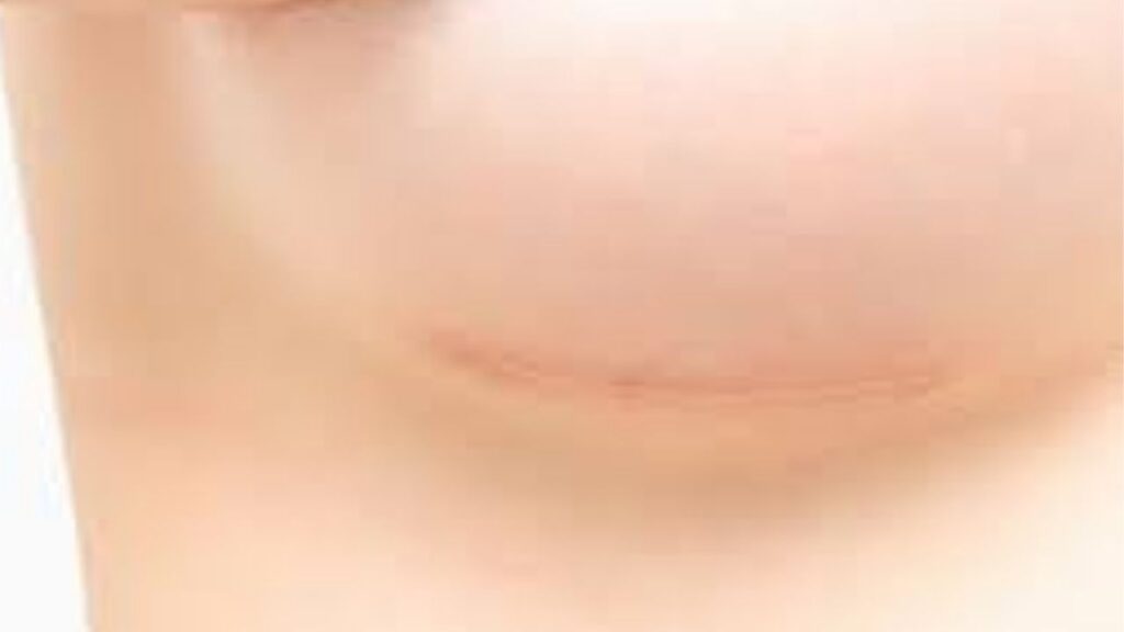 Nâng ngực có để lại sẹo không? Kỹ thuật giấu sẹo tàng hình và cách mờ sẹo sau 3 tháng