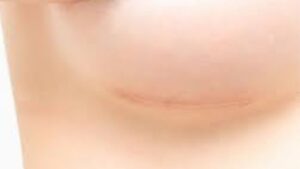 Nâng ngực có để lại sẹo không? Kỹ thuật giấu sẹo tàng hình và cách mờ sẹo sau 3 tháng