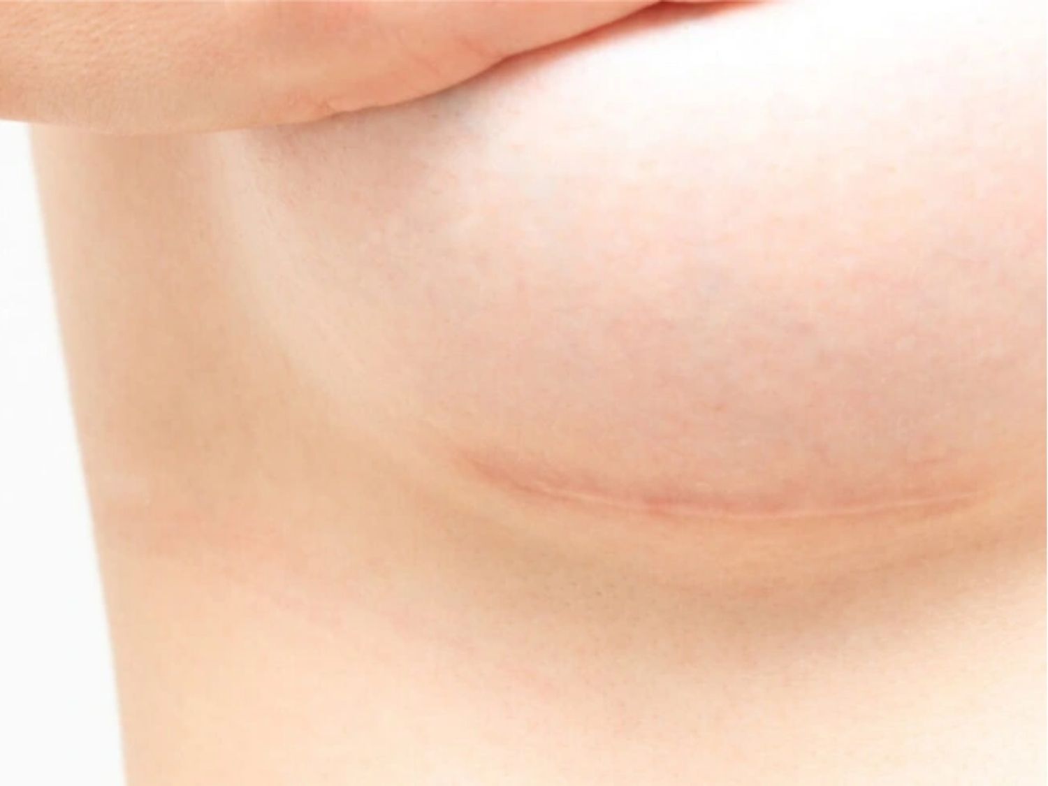 nâng ngực có thể để lại sẹo vì kỹ thuật này cần đường rạch nhỏ ở ngực để đưa túi ngực vào trong, ít nhiều sẽ có sẹo