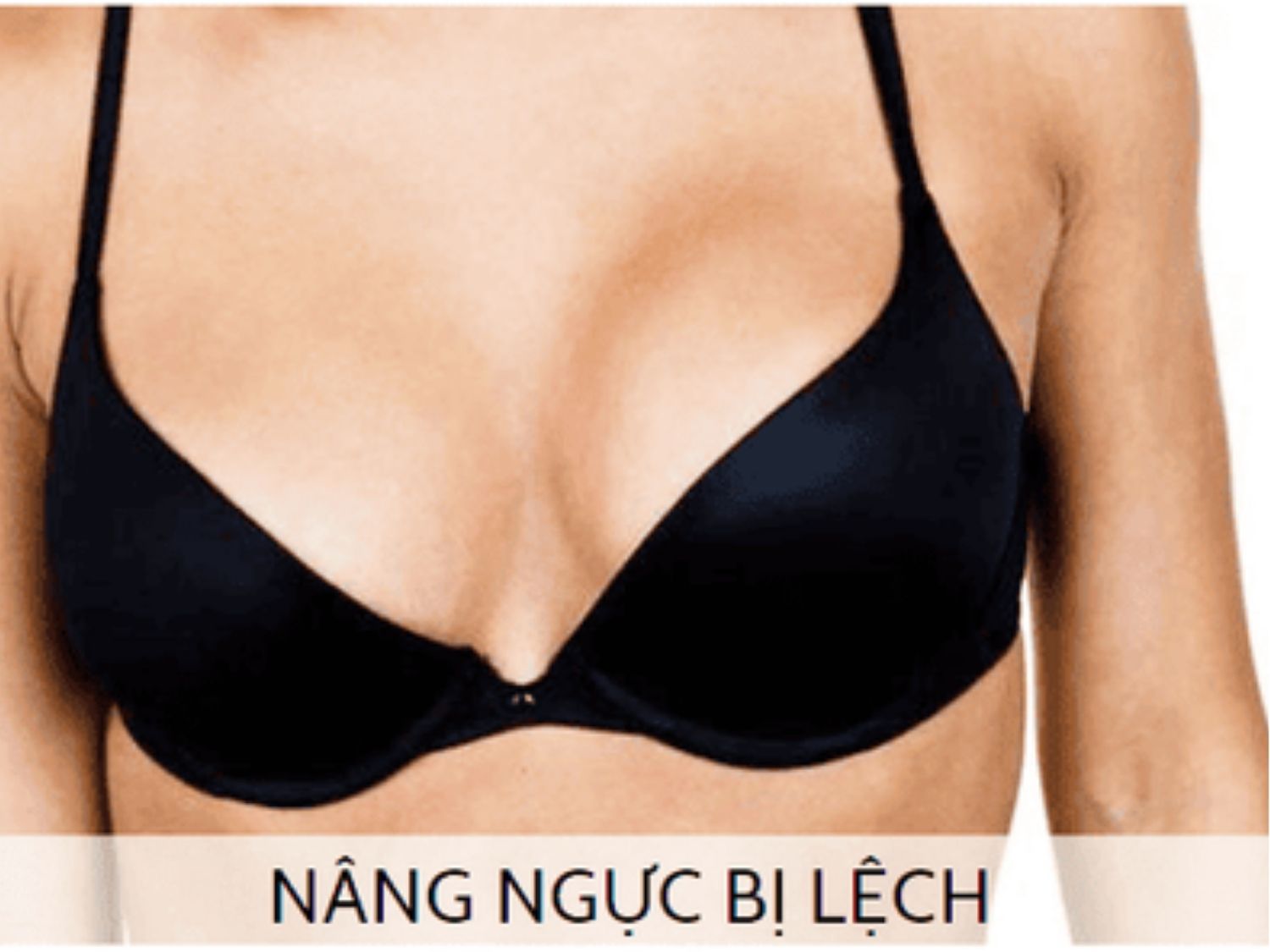 ngực lệch không cân đối là dấu hiệu nâng ngực bị hỏng