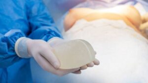 Nâng ngực có phải thay túi định kỳ không? Sự thật và Phác đồ an toàn