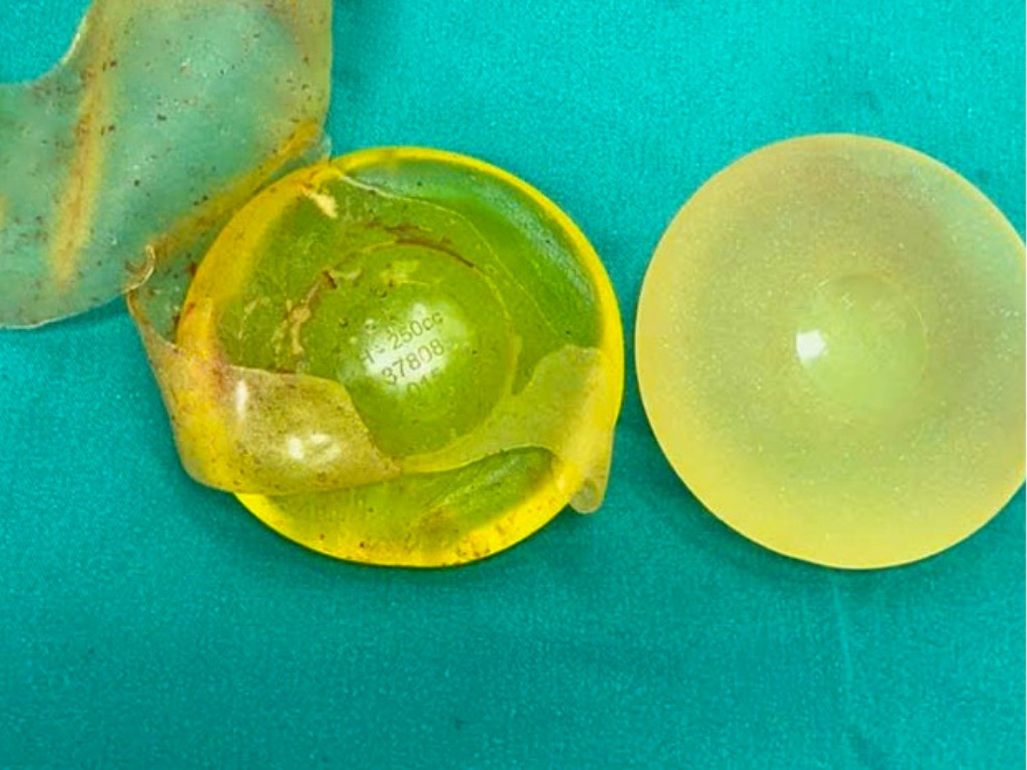 đây là ảnh tình trạng vỡ túi ngực sau nâng ngực