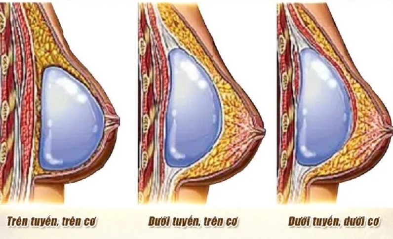 Vị trí đặt túi quyết định trực tiếp đến mức độ đau và tính thẩm mỹ lâu dài của bầu ngực.