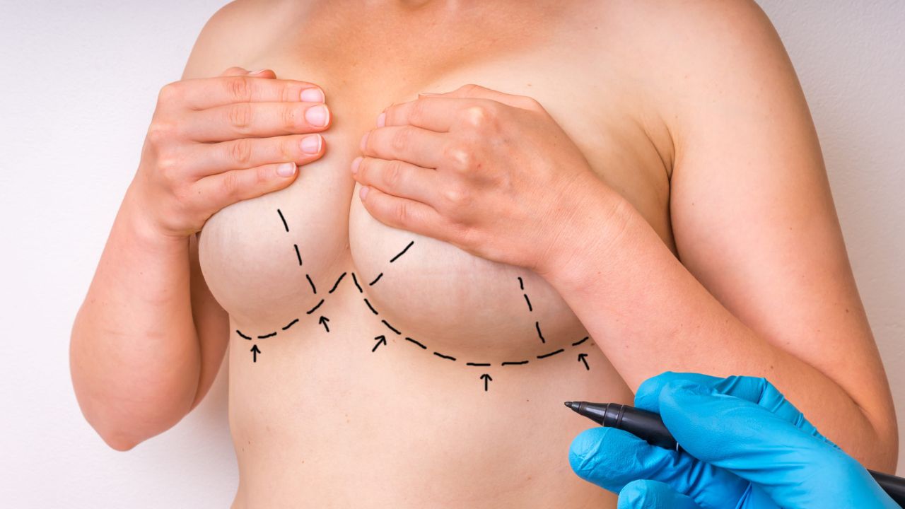 Sơ đồ vị trí đường rạch chân ngực trong phẫu thuật nâng ngực thẩm mỹ 