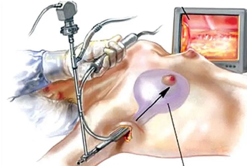 Sơ đồ so sánh vị trí đường mổ và chi phí nâng ngực đường nách so với các đường khác