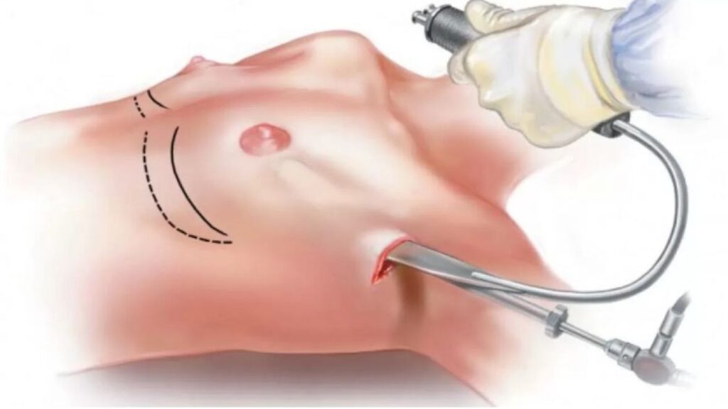 Nâng ngực đường nách là gì? Review độ đau và khả năng giấu sẹo 2026