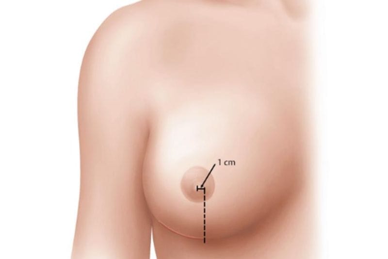 Nâng ngực đúng cách sẽ không ảnh hưởng đến cảm giác vòng 1
