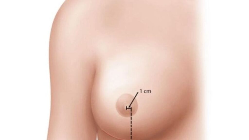 Nâng ngực đường quầng vú: Ưu nhược điểm và bí quyết bảo tồn cảm giác 2026