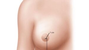 Nâng ngực đường quầng vú: Ưu nhược điểm và bí quyết bảo tồn cảm giác 2026