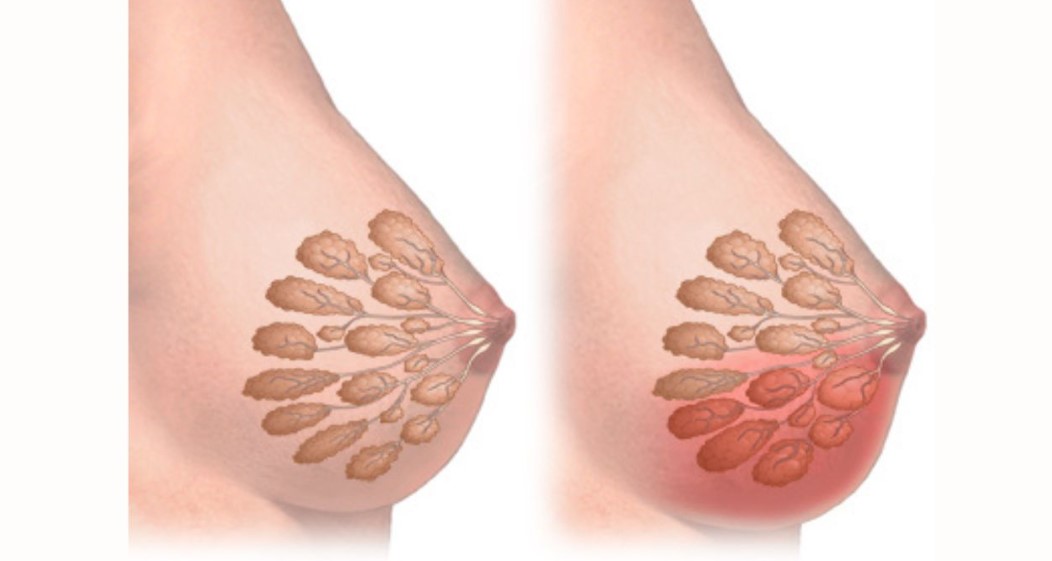  Mô phỏng tình trạng hoại tử mô vú do thiếu máu nuôi dưỡng sau phẫu thuật