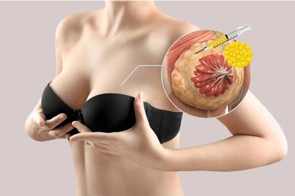 Mỡ tự thân được chọn lọc, chiết tách và bơm vào ngực