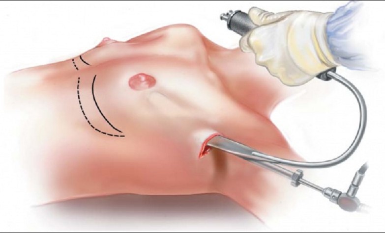 Nâng ngực nội soi, đặt túi ngực dưới cơ giúp giảm tình trạng bao xơ