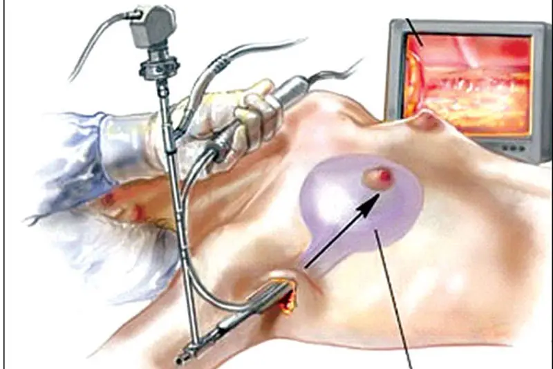 Nâng ngực nội soi là kỹ thuật đưa túi độn vào khoang ngực thông qua đường mổ nhỏ
