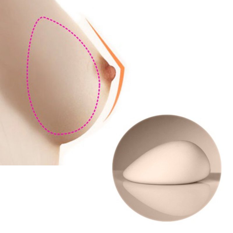 Túi ngực luôn nằm ngoài khung xương sườn, không có khả năng xâm nhập vào khoang nội tạng.