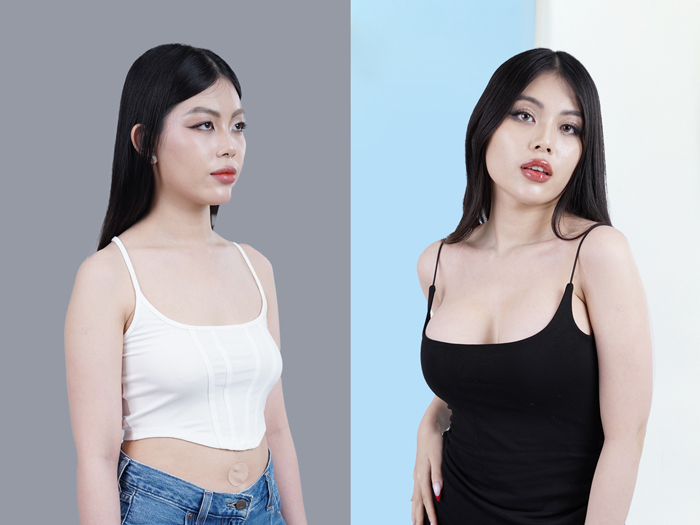 khách hàng nâng ngực xong tự tin hơn vì thân hình cân đối