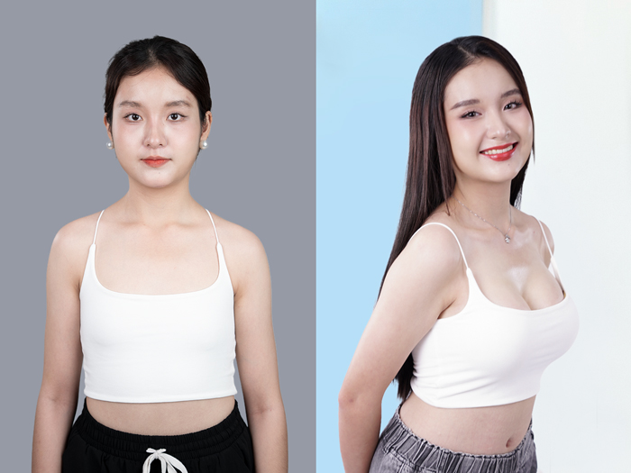 khách hàng sau nâng ngực sở hữu vòng 1 tự tin và duy trì vẻ đẹp lâu dài