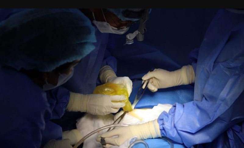 Bác sĩ thực hiện loại bỏ túi ngực bị bao xơ