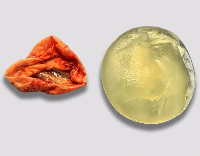 Lớp bao xơ xung quanh túi ngực