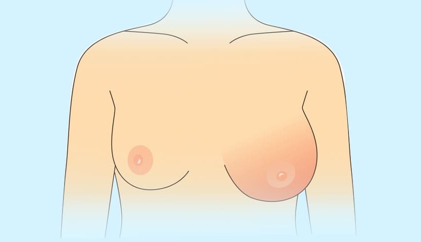 Ngực bị sưng có thể do tụ dịch một bên