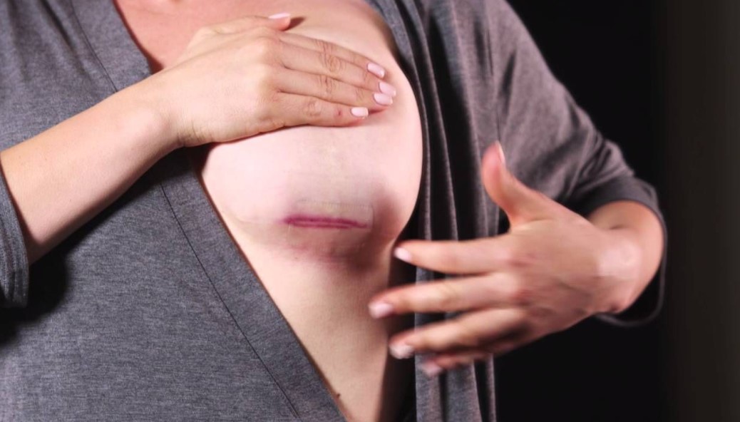 Tình trạng tụ dịch sau nâng ngực