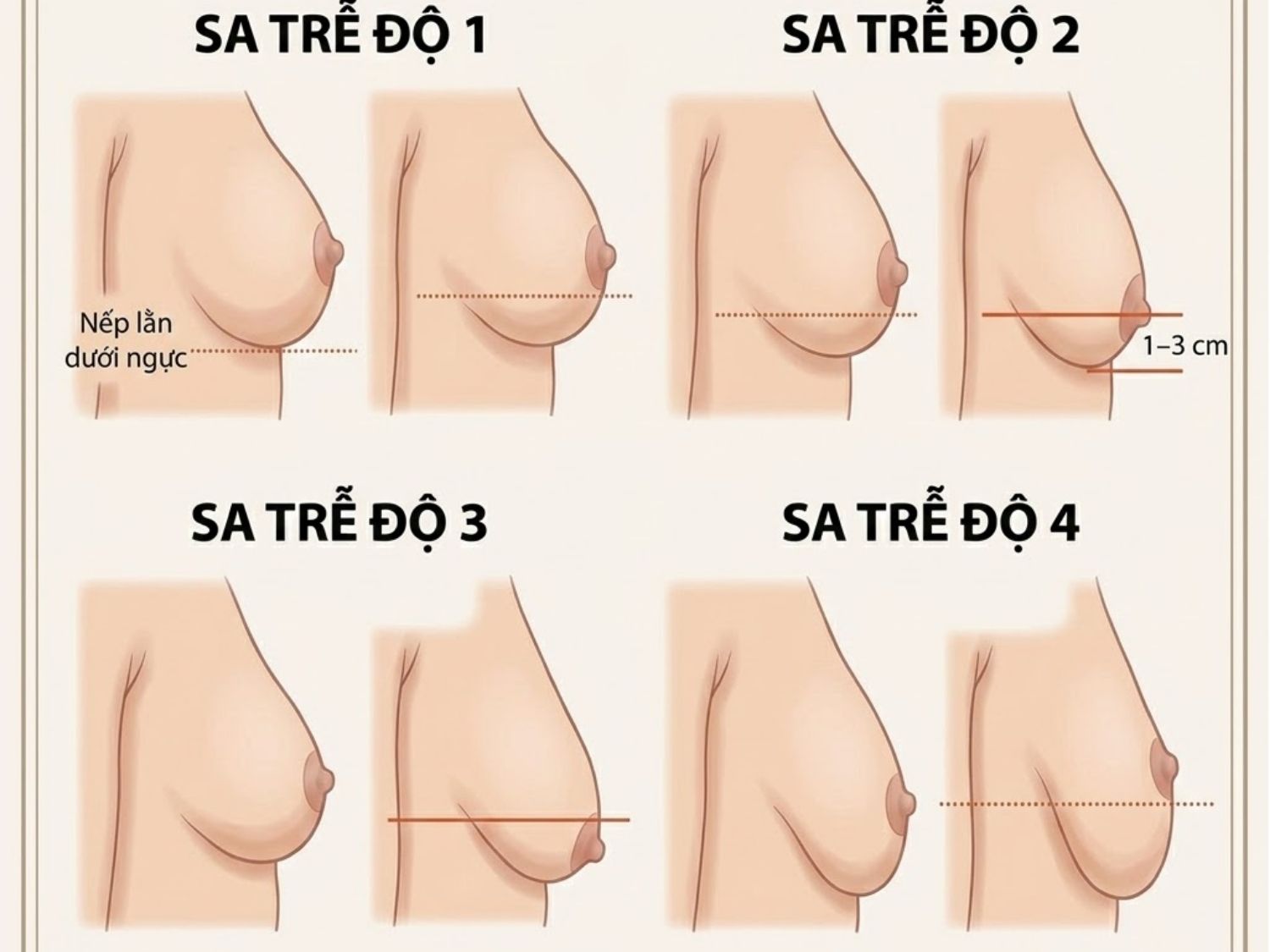 mô phỏng 4 cấp độ sa trễ ngực