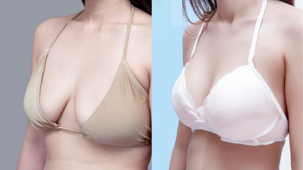 Ngực chảy xệ nên nâng hay treo sa trễ? 4 tiêu chí chọn đúng phương pháp tối ưu