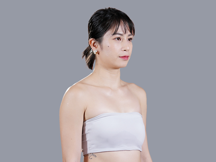 Tình trạng ngực teo lép, nhỏ và chảy xệ sau sinh