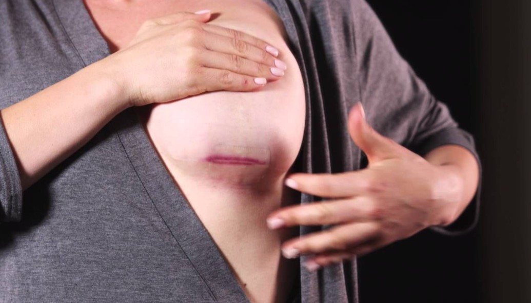 Ngực bị tụ dịch, có dấu hiệu nhiễm trùng sau nâng ngực