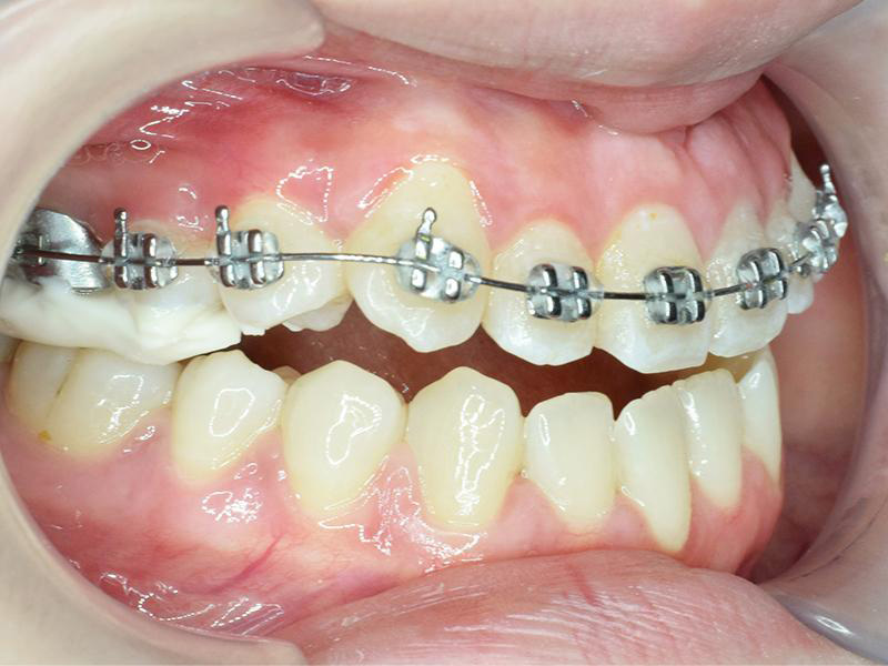 Niềng răng giúp dịch chuyển các răng về đúng trục, cải thiện tình trạng lệch hàm mức độ nhẹ do răng.