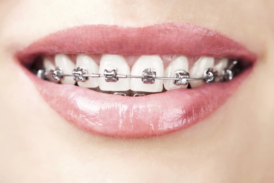 Phương pháp niềng răng điều trị móm nhẹ hiệu quả và thẩm mỹ.