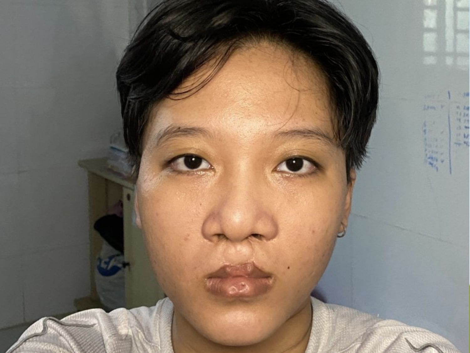 Di chứng sứt môi hở hàm ếch khiến gương mặt còn nhiều khuyết điểm