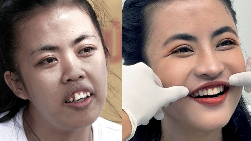 Chỉnh hàm hô là gì? Giải pháp phẫu thuật hô do xương và phục hồi khớp cắn