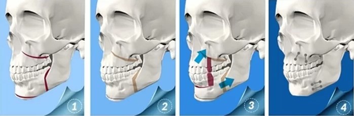 Kỹ thuật cắt xương tiền đình hàm trên và cố định bằng nẹp vít chuyên dụng trong phẫu thuật hàm hô.