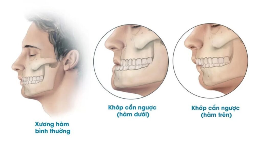 Phẫu thuật hàm mặt có ảnh hưởng dây thần kinh không? Tỉ lệ phục hồi và giải pháp bảo tồn cấu trúc