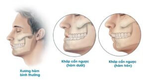 Phẫu thuật hàm mặt có ảnh hưởng dây thần kinh không? Tỉ lệ phục hồi và giải pháp bảo tồn cấu trúc