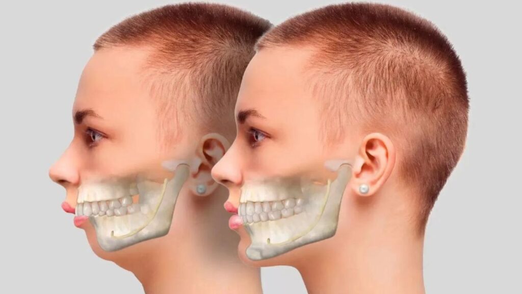 Phẫu thuật hàm mặt có cần truyền máu không? Khi nào mổ hàm có nguy cơ mất máu