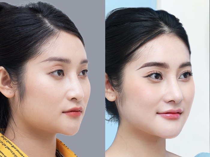Hình ảnh thực tế kết quả khách hàng trước và sau gọt hàm 6 tháng, cho thấy cấu trúc xương hàm ổn định hoàn toàn.