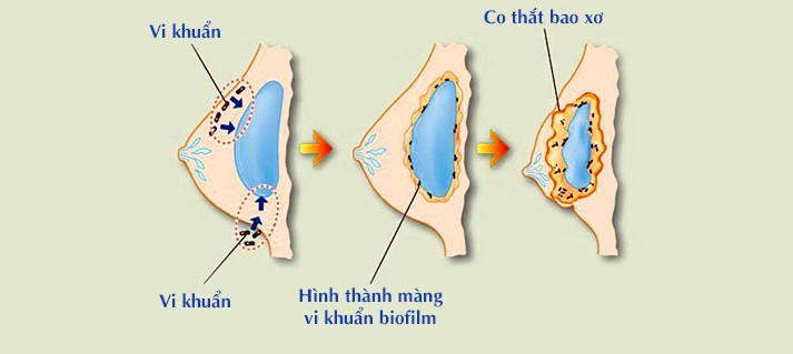 Quá trình túi ngực bị vi khuẩn xâm nhập gây bao xơ