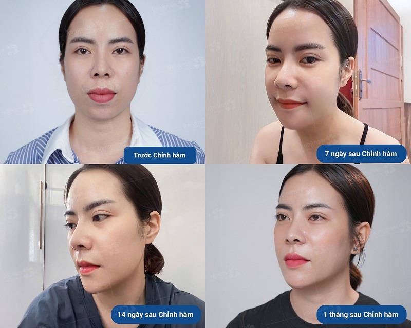 Hình ảnh quá trình phục hồi sau 1 tháng chỉnh hàm, gương mặt thon gọn chuẩn tỉ lệ vàng tại Bệnh viện Thẩm mỹ Kangnam.