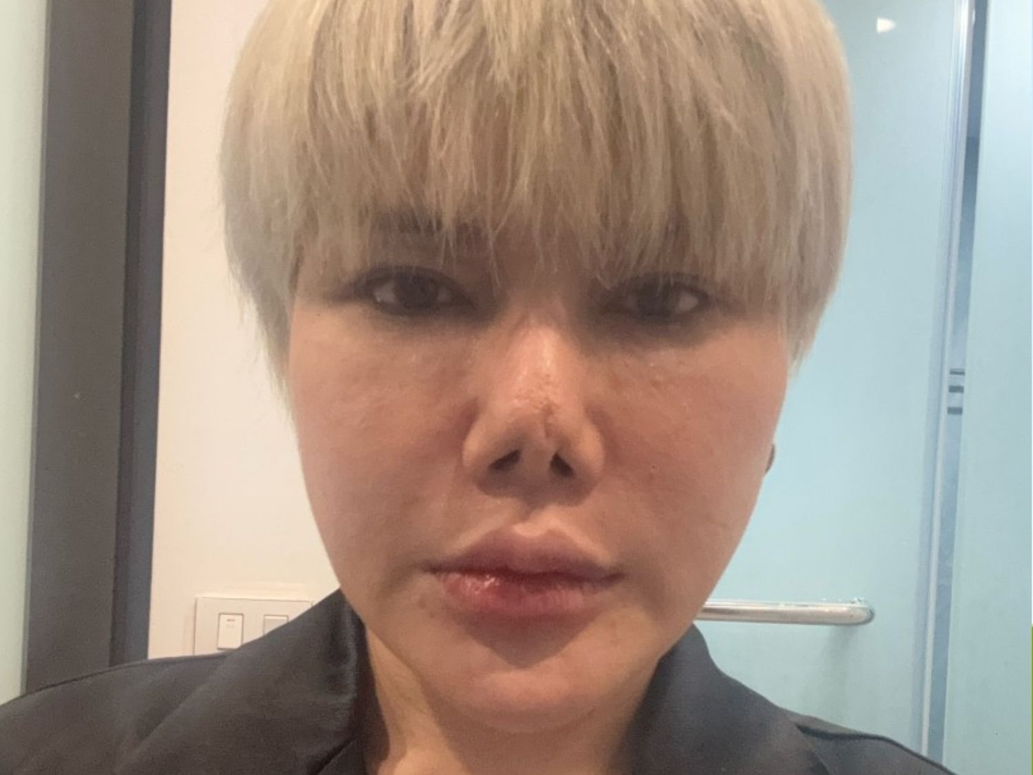 Tình trạng mũi hỏng sau 5 lần can thiệp